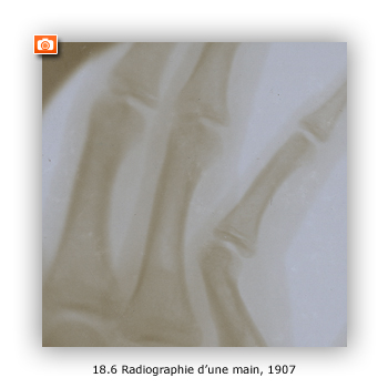 Radiographie d'une main réalisée à nice en 1907